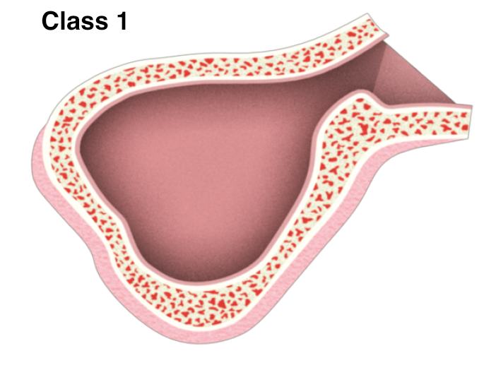 Sinus-11-1