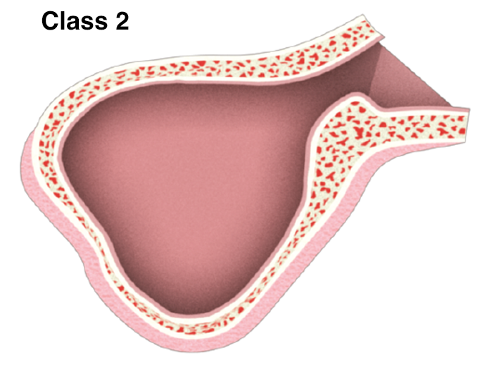 Sinus-22