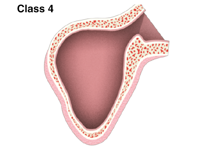 Sinus-44